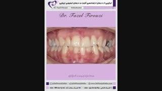 ترکیبی از درمان ارتودنسی ثابت و درمان دندانپزشکی زیبایی و ترمیمی | دکتر فاضل فیروزی