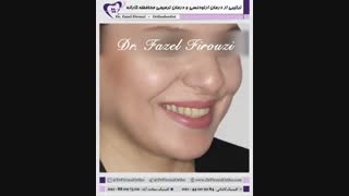 طراحی لبخند | دکتر فضال فیروزی