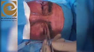 فیلم واقعی جراحی تومور پلک بالا