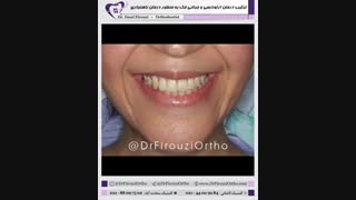 ترکیب درمان ارتودنسی و جراحی فک | دکتر فاضل فیروزی