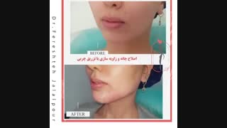 فیلم اصلاح چانه و زاویه سازی با تزریق چربی