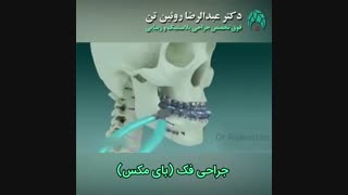 جراحی فک ( بای مکس ) | فوق تخصص جراحی پلاستیک | دکتر عبدالرضا روئین تن