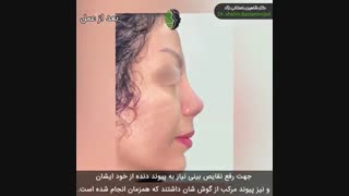 جراحی بینی ترمیمی پیچیده | بهترین جراح بینی ترمیمی | دکتر باستانی نژاد