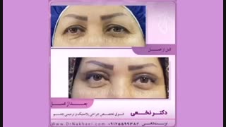 فیلم نمونه جراحی بلفاروپلاستی پلک فوقانی خانم 46 ساله