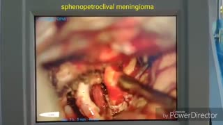 تومور بزرگ مننژیوم قاعده جمجمه