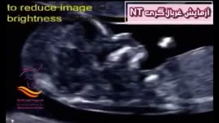 سونوگرافی nt