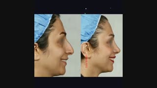 فیلم عمل افتادگی بینی