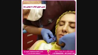 چربی سوزی غبغب با مزوتراپی و نخ