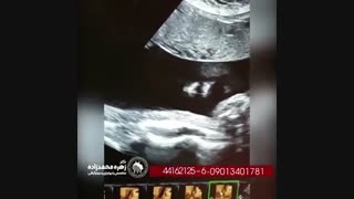 سونوگرافی متحرک
