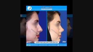 نمونه عکس های جراحی بینی فانتزی و نیمه فانتزی | دکتر گلی