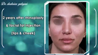 دو سال بعد از جراحی بینی توسط دکتر شهریار یحیوی