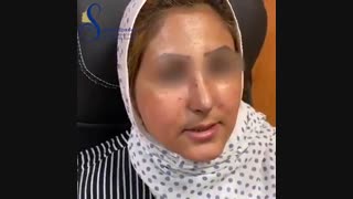 نمونه جراحی زیبایی بینی