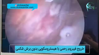 فیلم خروج فیبروم رحمی به روش هیستروسکوپی بدون هیچگونه برشی!