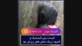 سندروم تخمدان پلی کیستیک و رییزش مو