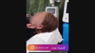 ارتباط ویروس کرونا با ریزش مو؟!