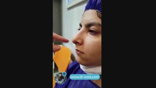 عمل بینی ستخوانی غضروفی با انحراف شدید