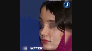 یک سال و نیم بعد از جراحی بینی نیمه فانتزی توسط دکتر گلی