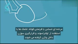 درمان ناباروری با روش ivf (آی وی اف)