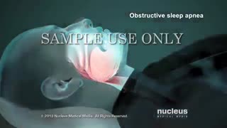 آپنه در خواب چیست ؟