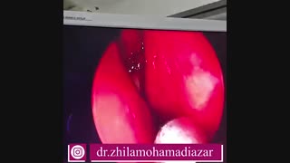 جراحی سینوس بدون برش و بخیه