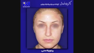 فیلم نمونه کار رینوپلاستی