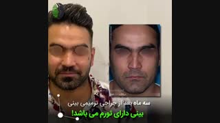 جراحی ترمیمی بینی به روش ابداعی دکتر باستانی نژاد