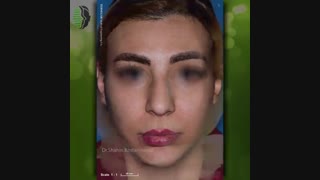 نمونه کار جراحی زیبایی بینی | دکتر باستانی نژاد | جراح بینی تهران