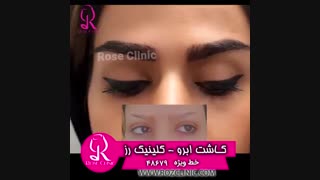 فیلم کاشت ابرو | کلینیک رز | 09104440228 | شماره 211