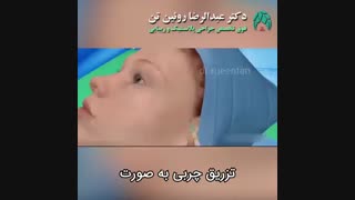 تزریق چربی به صورت | فوق تخصص جراحی پلاستیک | دکتر عبدالرضا روئین تن