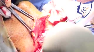 فیلم واقعی جراحی تومور کف دهان