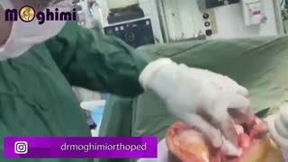 تعویض مفصل زانوی راست در خانم ۵۸ ساله دچار آرتروز دردناک