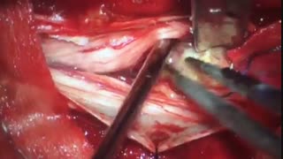 انجام جراحی تومور نخاع به روش میکروسکوپی