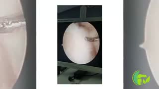 خانم میانسال با درد زانو