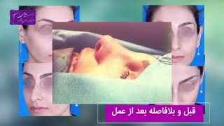 فیلم واقعی رینوپلاستی