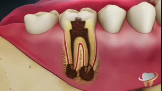 درمان ریشه | دکتر حامد صالحی