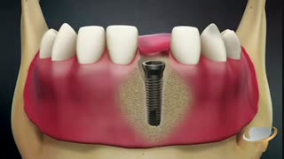 جراحی ایمپلنت با روش پیوند استخوان چیست؟ | دکتر حامد صالحی