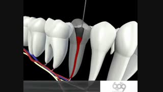 عصب کشی دندان-www.pardisdental.ir