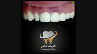 درمان ترکیبی روکش و لمینیت سرامیکی | دکتر حامد صالحی