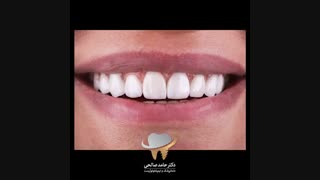 اصلاح طرح لبخند با استفاده از 8 واحد لمینت سرامیکی | دکتر حامد صالحی