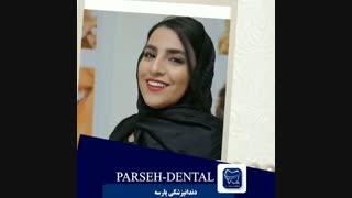 نتیجه بعد از ونیر کامپوزیت فک بالا در دندانپزشکی پارسه