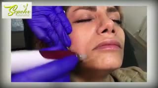 فیلم نحوه میکرونیدلینگ برای خانمی جوان لیفت ابرو