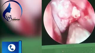 فیلم جراحی تومور مغزی