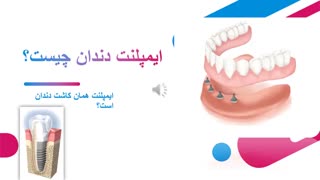 ایمپلنت دندان چیست؟