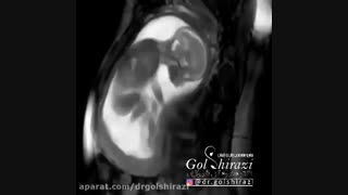 حرکت های جنین در شکم مادر