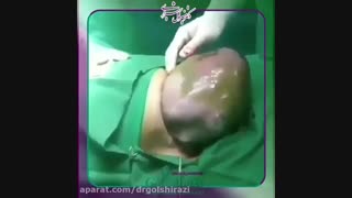 تولد نوزاد با کیسه اب
