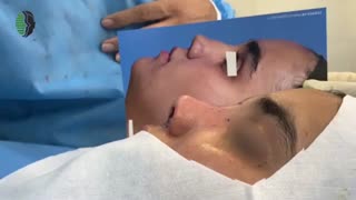 جراحی بینی زینی شکل | دکتر باستانی نژاد | جراح بینی تهران