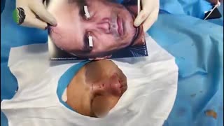 جراحی ترمیم بینی با غضروف دنده توسط دکتر باستانی نژاد