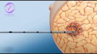 مارکرگذاری تومور پستان