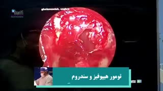 فیلم تومور هیپوفیز و سندرم نلسون