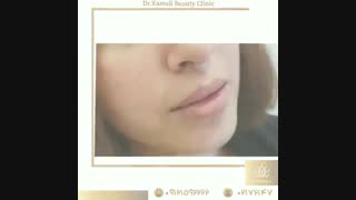فیلم واقعی تزریق ژل لب با متد روسی